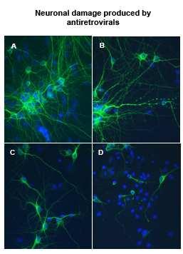 Neuronal damage and ART Neurons stained for microtubule-associated protein-2 (MAP-2): (A) normal untreated cultures (B) dendritic beading (C) pruning of dendrites (D) loss of neuron density Following