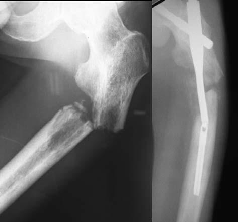Intramedullary nail with locking screw reconstruction. For the 11 patients with trochanteric to subtrochanteric metastasis, the short type of gamma nail was used for bony fixation.