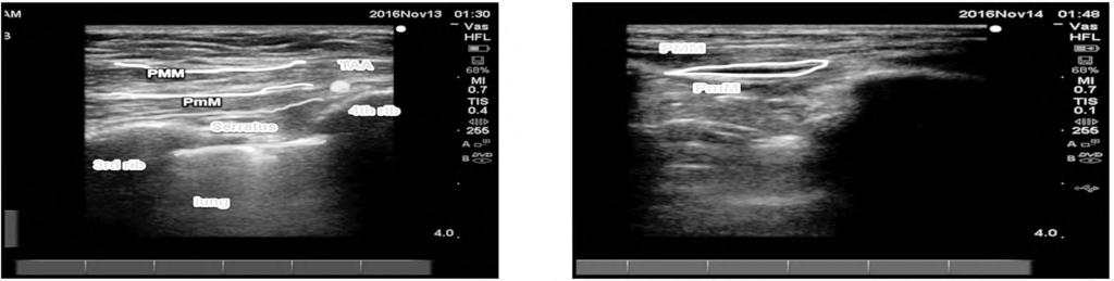 192 Ultrasound Guided Modified Pectoral Nerves Block versus Thoracic Paravertebral Block Fig.