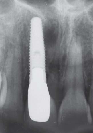Nicholas Caplanis et al Fig. 3A: Radiograph of a failing maxillary right central incisor Fig.