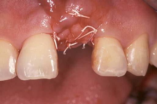 soft-tissue thickness or compensate for the thin biotype where recession is anticipated.