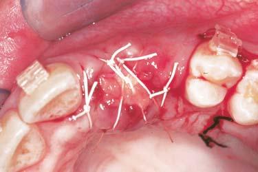 Placement of a graft material serves to preserve the existing alveolus.