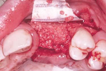 The addition of a connective tissue graft will help enhance the softtissue profile and prepare for future primary closure during the subsequent