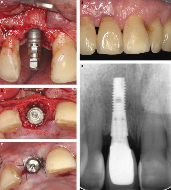 4-month period of healing following immediate implant placement into an extraction socket.