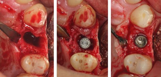 nounced in small defects. This observation indicates that large buccal gaps present following immediate implant installation will not predictably be completely resolved.