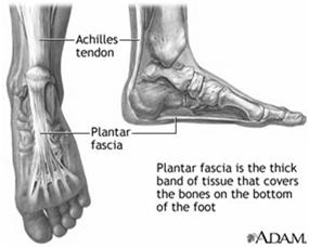 equinus/heel wedge Heel Pain Plantar Fasciitis Repetitive