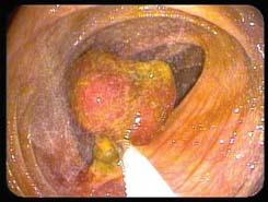 Colonoscopy Sessile Polyps A : the endoscopic appearance of early FAP and the difficulty in identifying adenomas B :
