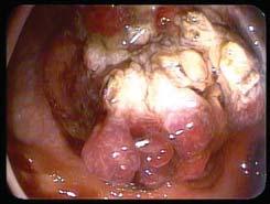MAP (MHY associated polyposis) Juvenile Polyposis Age of Presentation Hereditary Polyposis # of polyps Colorectal CA 16
