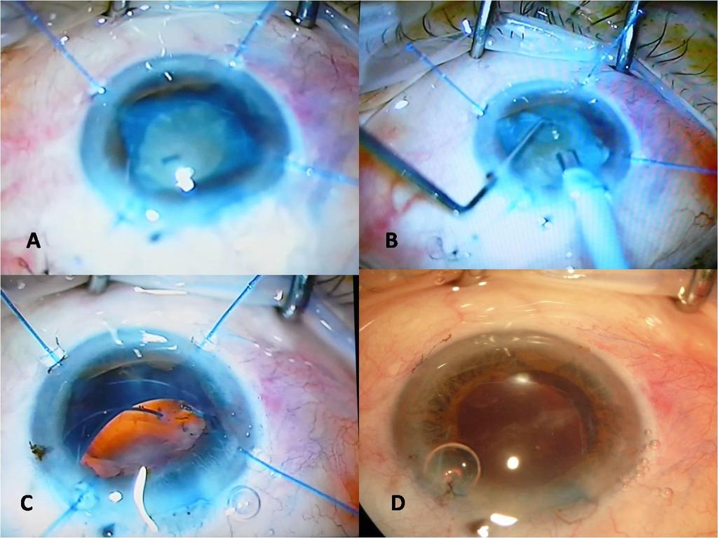 Iranian Journal of Ophthalmology Volume 24 Number 4 2012 full pharmacological measures and synechiae release, pupil diameter was not more than 4 mm. Iris hooks were inserted.