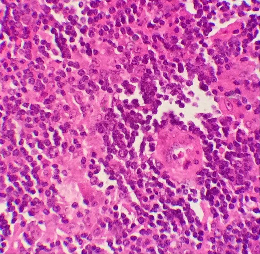 by diffuse immunoblastic large cells proliferation. These scattered large neoplastic cells are present on a background rich in histiocytes and small lymphocytes (Fig. 2).