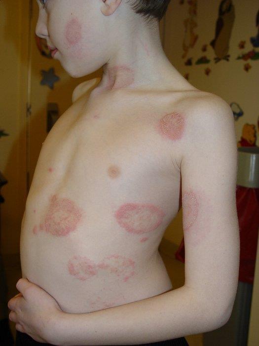 Clinical pictures: Red, itchy scaly rash, ring like with raised more inflammed border on the body or groin.
