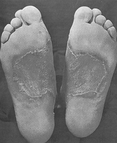 Dermatophytosof the soles