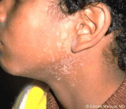 Superficial Malessezia infections Pityriasis versicolor: : Clinically: