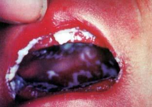 Candidiasis Acute Pseudomembraneous Candidiasis (Thrush) A clinical form of