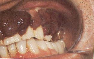 Kaposi s Sarcoma(KS) KS may be seen anywhere in the oral cavity, including the gingiva