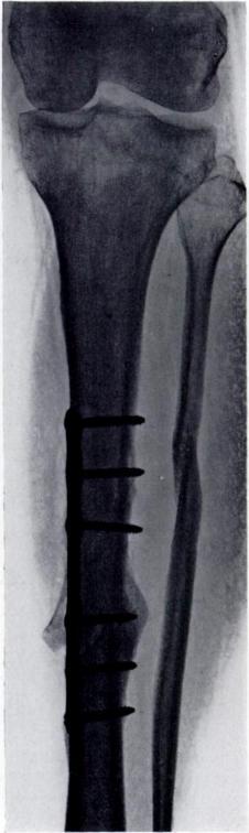 6 Irreducible displacement-one of the rare indications for open reduction and internal fixation (Figs. 4 and 5). The sharp edge of the displaced middle fragment was threatening to perforate the skin.