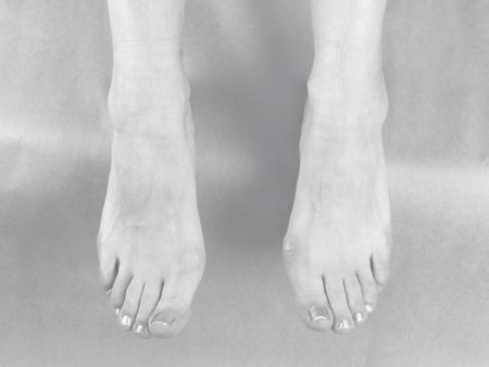 aspect of the second met head (along the long axis of the foot), a