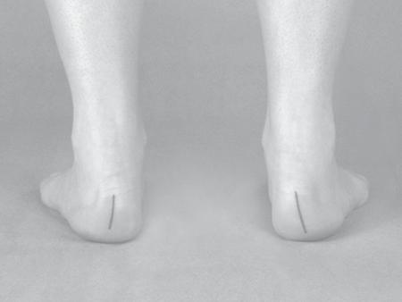CALCANEAL STANCE POSITION: NEUTRAL SUBTALAR Inverted Rectus Everted