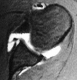 Labral- Ligamentous Periosteal