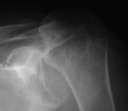 concepts SLAC shoulder Microinstability 9 12 6 3 Accounts for 2-4% of all GHJ dislocations Over 50% unrecognized at presentation Physical