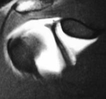 Sublabral Hole