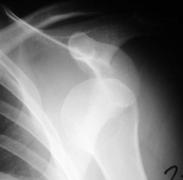 Subcoracoid Subglenoid Subclavicular Intrathoracic Intraabdominal Accounts for 95% of GHJ dislocation Mechanism