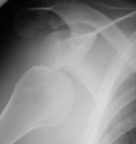 Dislocation Most common type of anterior dislocation Subcoracoid-Subglenoid Dislocation Complications Hill Sach s