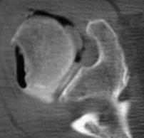 of glenoid fossa Best diagnosed on internal rotation view Subcoracoid-Subglenoid Dislocation Complications