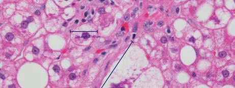 Definition of Ballooning Cell is enlarged beyond backround, nonsteatotic hepatocytes Cytoplasm is altered by clearing