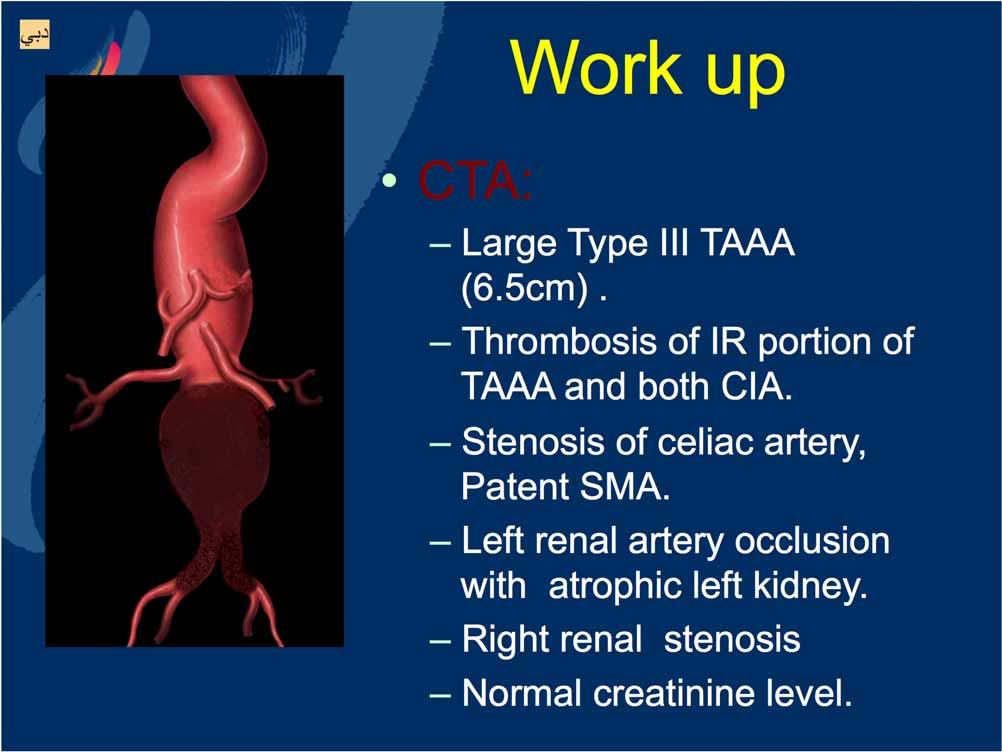 Work up CTA: Large Type III TAAA (6.5cm). Thrombosis of IR portion of TAAA and both CIA.