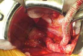 Calcified/Narrow Iliac Arteries Try