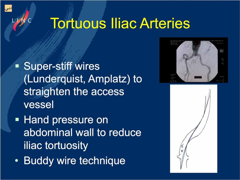 Tortuous Iliac Arteries Super-stiff wires (Lunderquist, Amplatz) to straighten the
