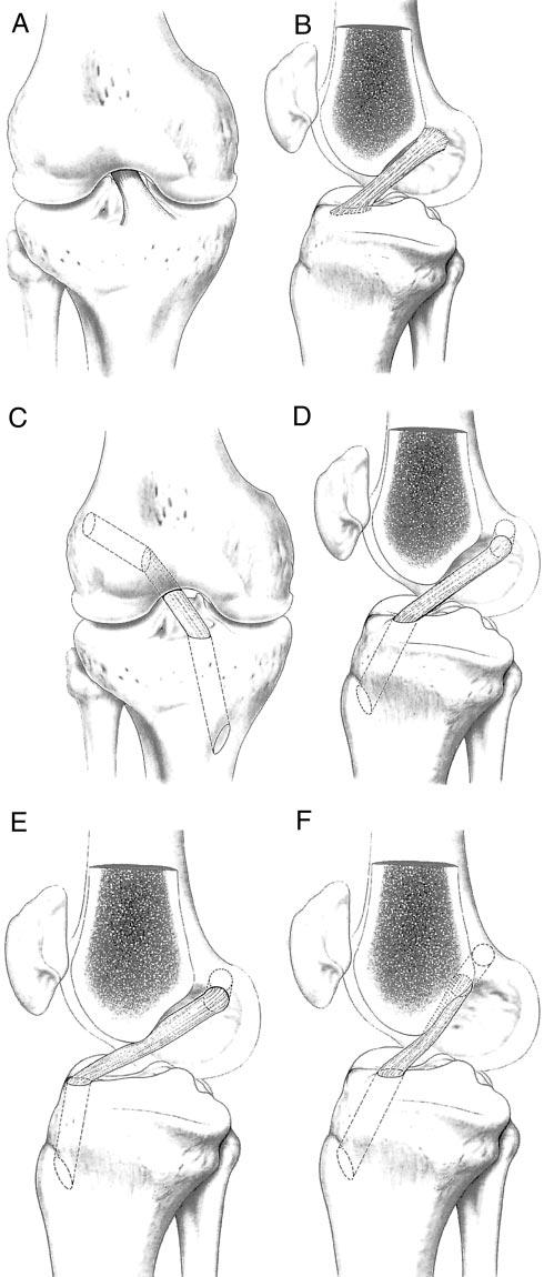 668 Millett et al. American Journal of Sports Medicine interfere with normal knee kinematics. 49 Graft position must be accurate in all planes and at both the tibial and femoral tunnels.