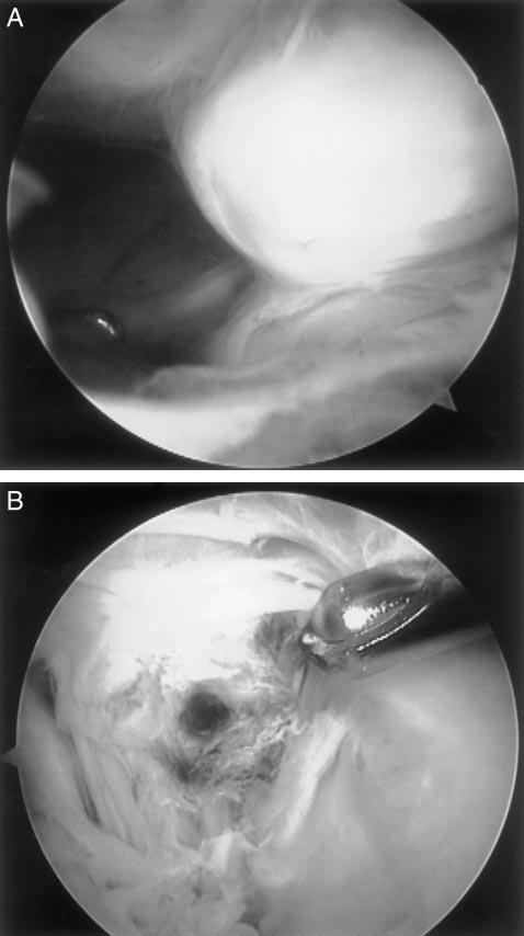 670 Millett et al. American Journal of Sports Medicine block to extension. Whether they result from bony overgrowth of the tibial tunnel or from repetitive trauma remains unclear.