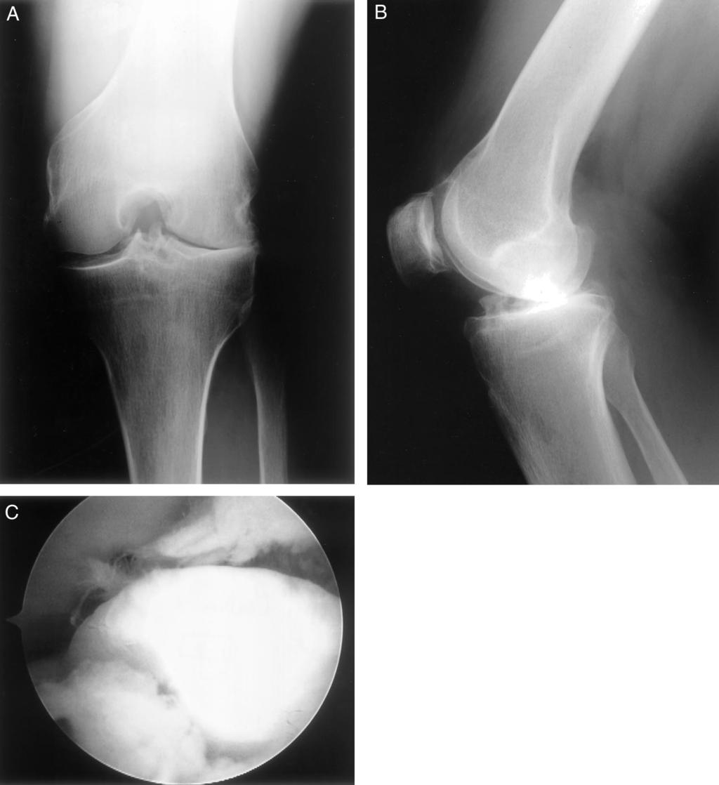 Vol. 29, No. 5, 2001 Motion Loss after Ligament Injuries to the Knee 671 Figure 4.