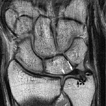 Imaging - MRI Radial attachment of articular disk at sigmoid notch