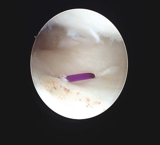 Treatment Options for IB Tears Arthroscopic repair Outside-inside using meniscal repair