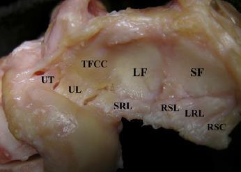 Anatomy of the TFCC Fibrocartilaginous articular disk Load transmission