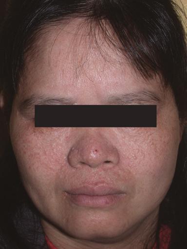 Use of CO2 Laser in the Treatment of Periungual Fibromas of Tuberous Sclerosis Complex Chen-Hsi Hung Kuo-Chia Yang CASE REPORT A 47-year-old woman came to our dermatological out-patient department