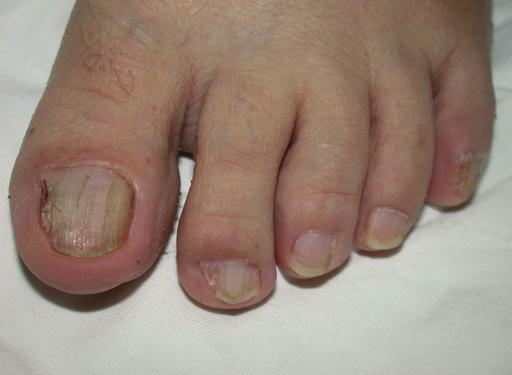 The lesions were painful and bled upon contact, resulting in difficulty on shoe wearing.