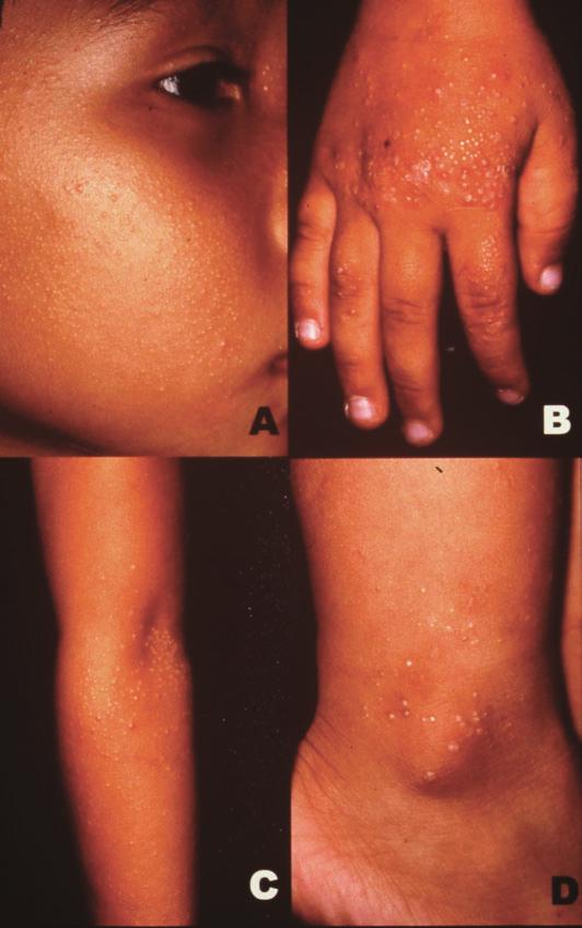 Resident Forum Numerous Minute Round Glistening Papules on Photodistributed Skin in a 4-year-old Boy Chien-Te Lin 1 Kung-Kai Lin Gwo-Shing Chen CASE REPORT A 4-year-old boy experienced numerous