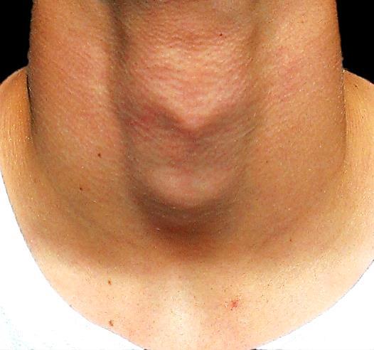 In the more thickset patient, make a 3cm vertical midline incision extending inferiorly from the thyroid prominence (Figure 16); dissect bluntly down to the cricothyroid membrane with the