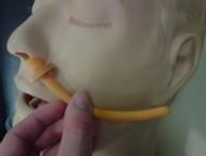 The nasal airway is well lubricated with lignocaine jelly and inserted with the bevel toward the septum.