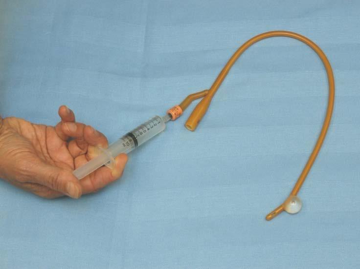 Indwelling foley catheter An indwelling foley catheter is a sterile rubber or plastic tube