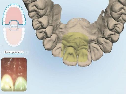 These scan helps to ensure that lingual and buccal segments are