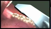 Capture the Occlusal Segment of an Arch To scan the occlusal surface, move in a single continuous motion.