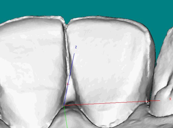 actual tooth anatomy, the scan has not accurately registered; and it