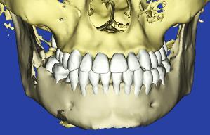 Ordering a Therapeutic Model from a CBCT Scan and a Supplemental Scan A supplemental scan is used to add data from an optical scan