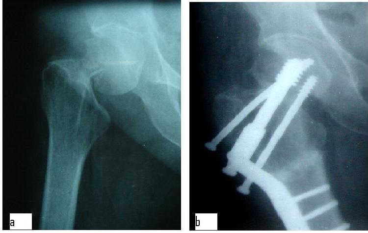 narrowing Some limitation of motion and moderate pain with degenerative changes or aseptic necrosis Severe restriction of function and pain requiring salvage procedure Union is defined as bridging of