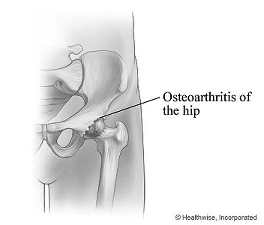 Common causes of joint replacement Osteoarthritis is a degenerative joint condition affecting the cartilage on the end of bones, caused by